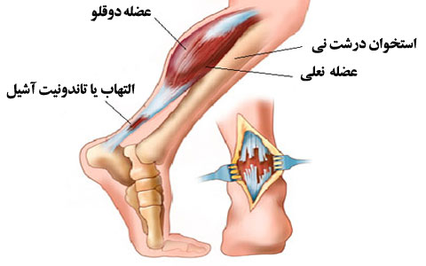 Inflammation-of-the-Achilles